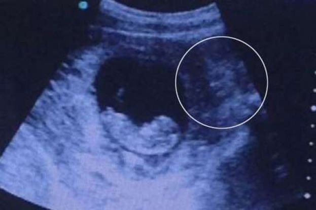 FA L'ECOGRAFIA AL BIMBO IN PANCIA ,QUELLO CHE APPARE SCIOCCA TUTTI
